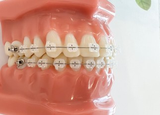Straightening Smiles with Braces: A Guide for Parents