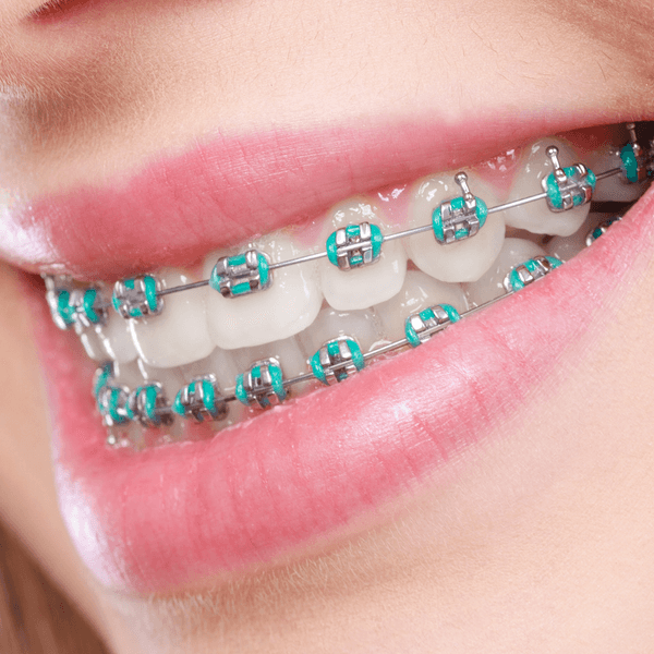 Navigating the Costs of Orthodontic Treatment: What to Expect on Your Journey to a Beautiful Smile
